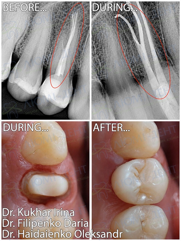 Повторное эндодонтическое лечение зуба 1.4 врач Кухар Ирина Повторное эндодонтическое лечение зуба 1.4